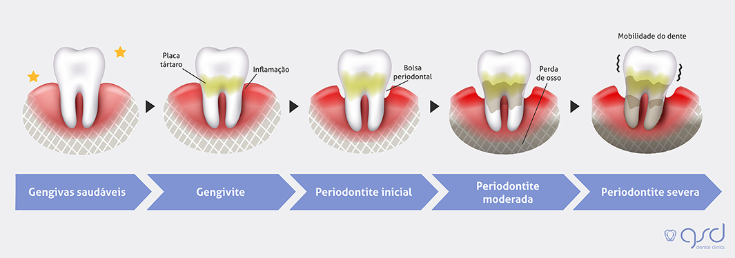 doencas-periodontais-gengivite-periodontite_1_.jpg